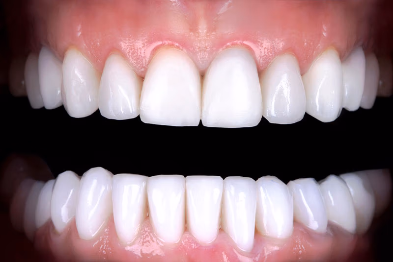 close up of before and after dental procedure