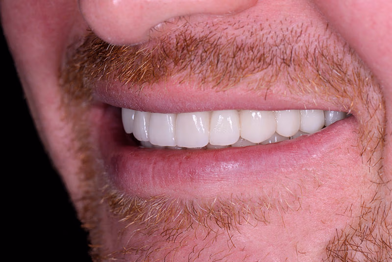 close up of before and after dental procedure