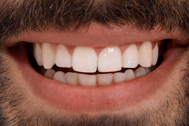 close up of before and after dental procedure