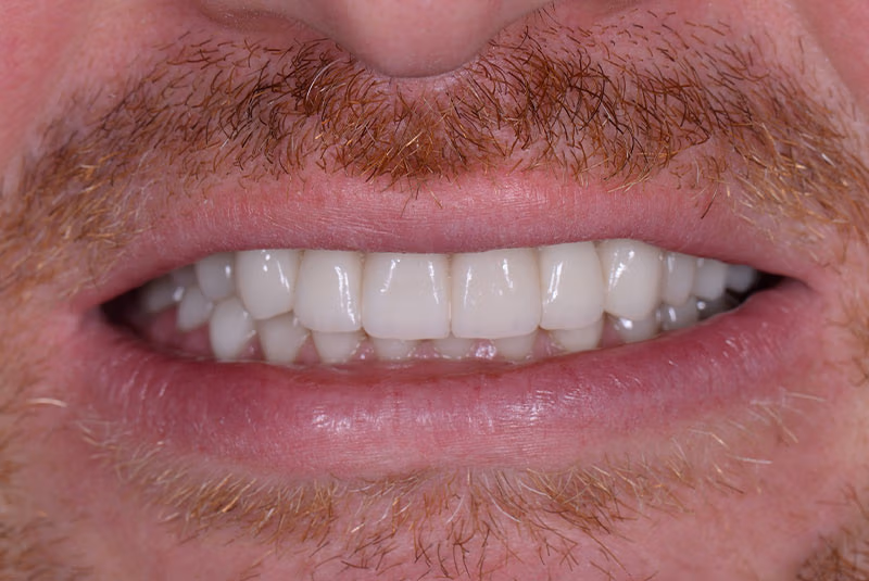 close up of before and after dental procedure