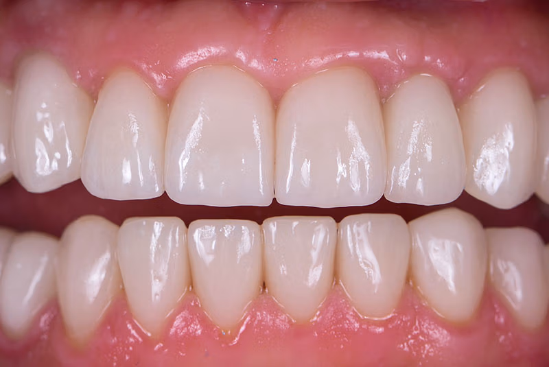 close up of before and after dental procedure