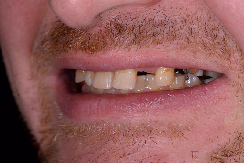 close up of before and after dental procedure