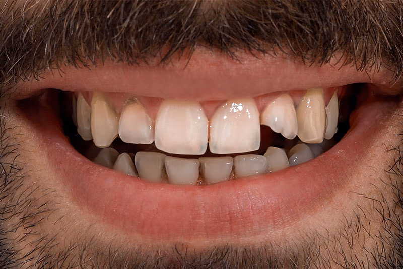 close up of before and after dental procedure