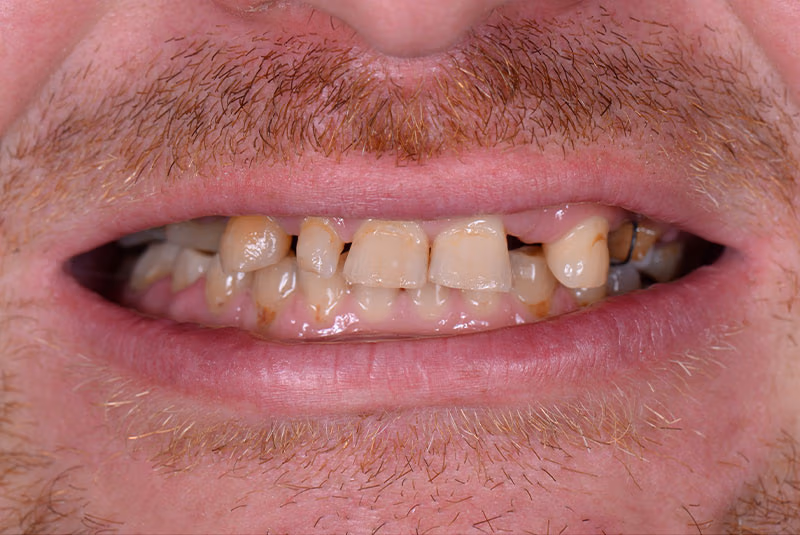 close up of before and after dental procedure