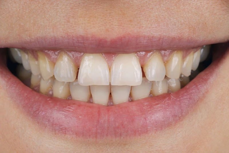 close up of before and after dental procedure