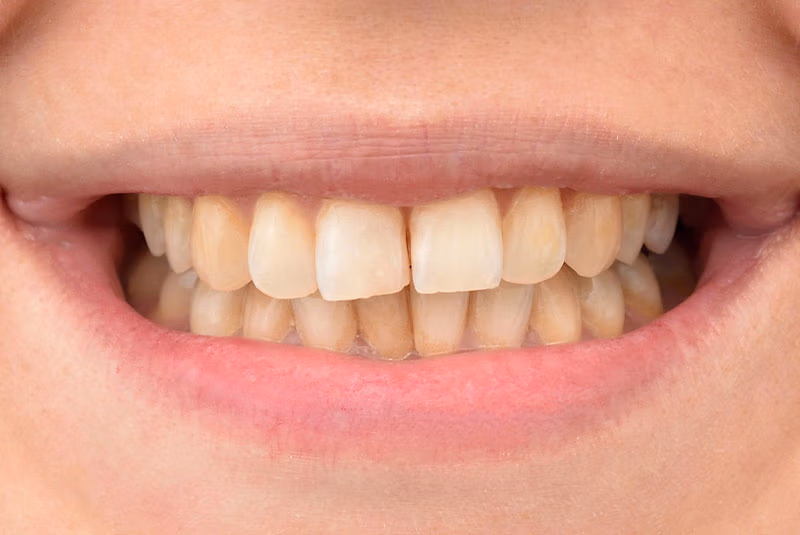 close up of before and after dental procedure